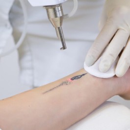 Sesión Eliminación de Tatuaje