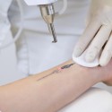 Sesión Eliminación de Tatuaje