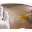 Sesión Carboxiterapia Corporal