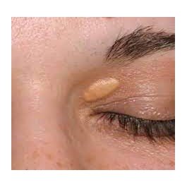 Sesión tratamiento de Xantelasmas, Siringomas