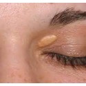 Sesión tratamiento de Xantelasmas, Siringomas