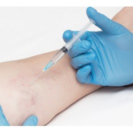 Sesión tratamiento Esclerosis de Varices