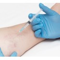 Sesión tratamiento Esclerosis de Varices