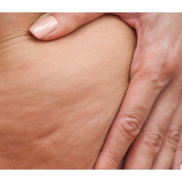 Sesión tratamiento Reducción Celulitis con Alidya