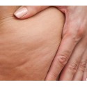 Sesión tratamiento Reducción Celulitis con Alidya
